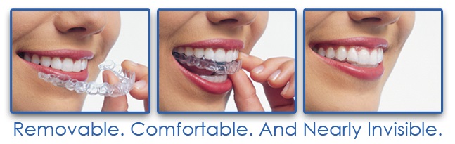 Invisalign Orthodontic Treatment