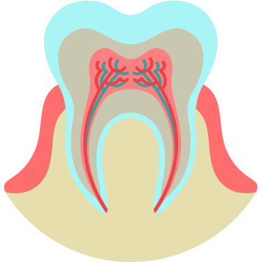 Root Canal Treatment (RCT)